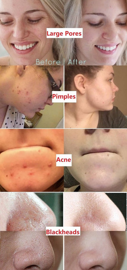 Hotplex™Natural Green Tea Clay Mask– Clears Acne & Refines Pores🌿