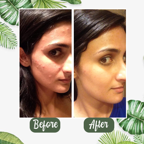 Hotplex™Natural Green Tea Clay Mask– Clears Acne & Refines Pores🌿